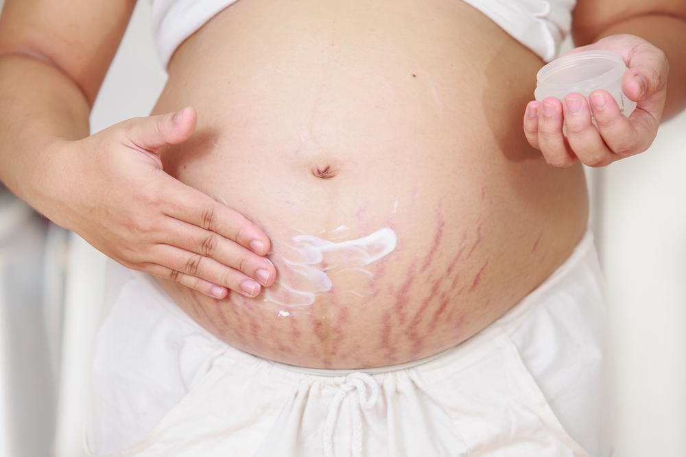 Zupfmassage – Kann sie Schwangerschaftsstreifen reduzieren?