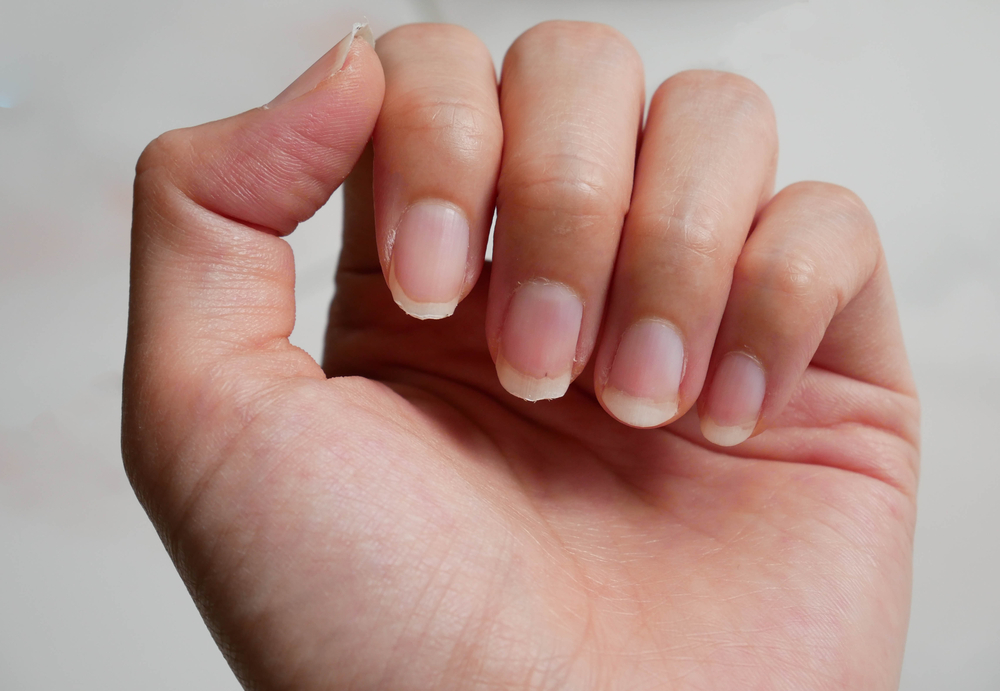 Fingernail,Lack,Of,Nutrients,And,Do,Not,Make,Nail,Not